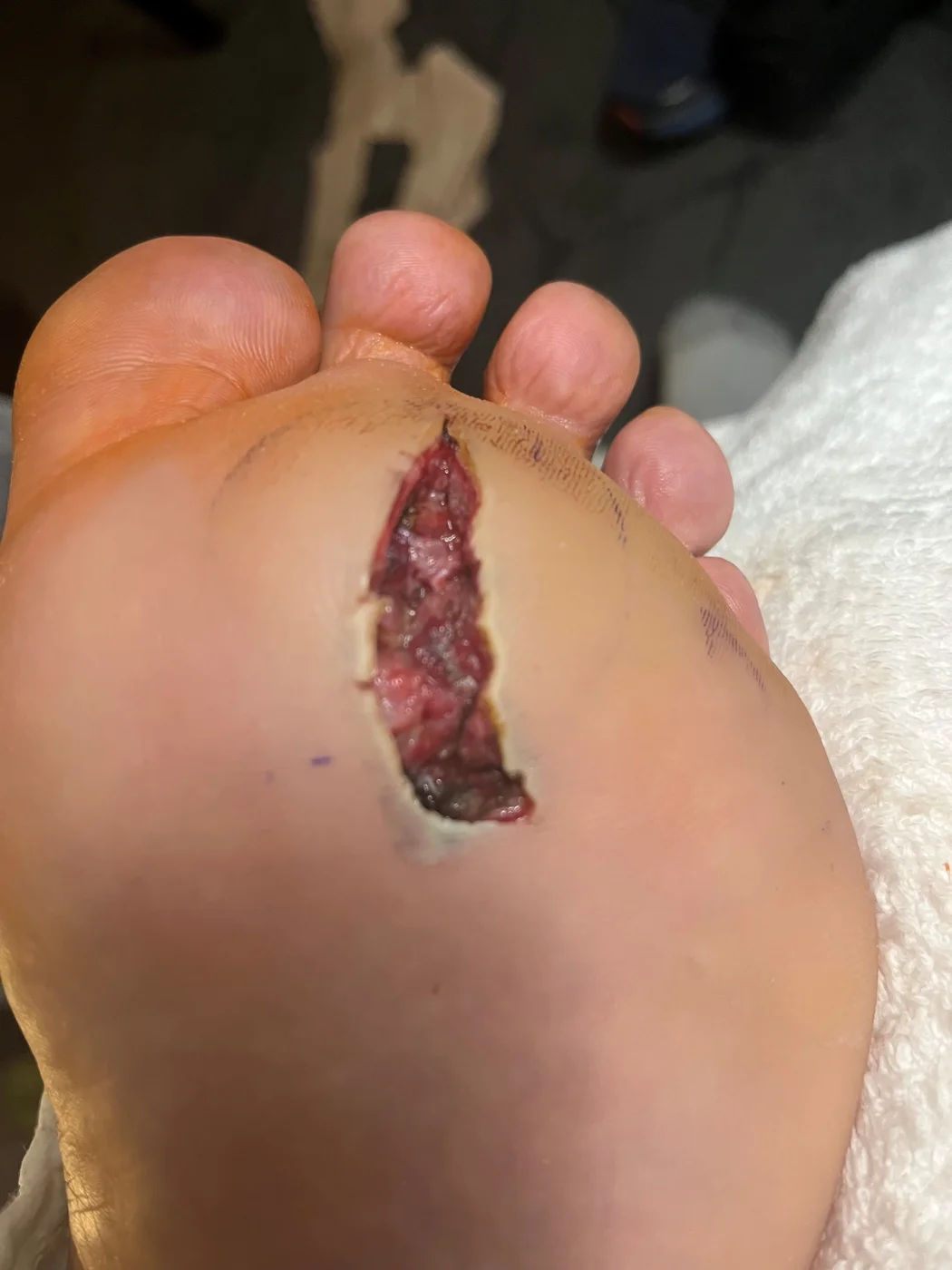 Initial diabetic foot ulcer prior to treatment
